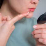 Acne Around Mouth: Why It Happens and How to Stop It