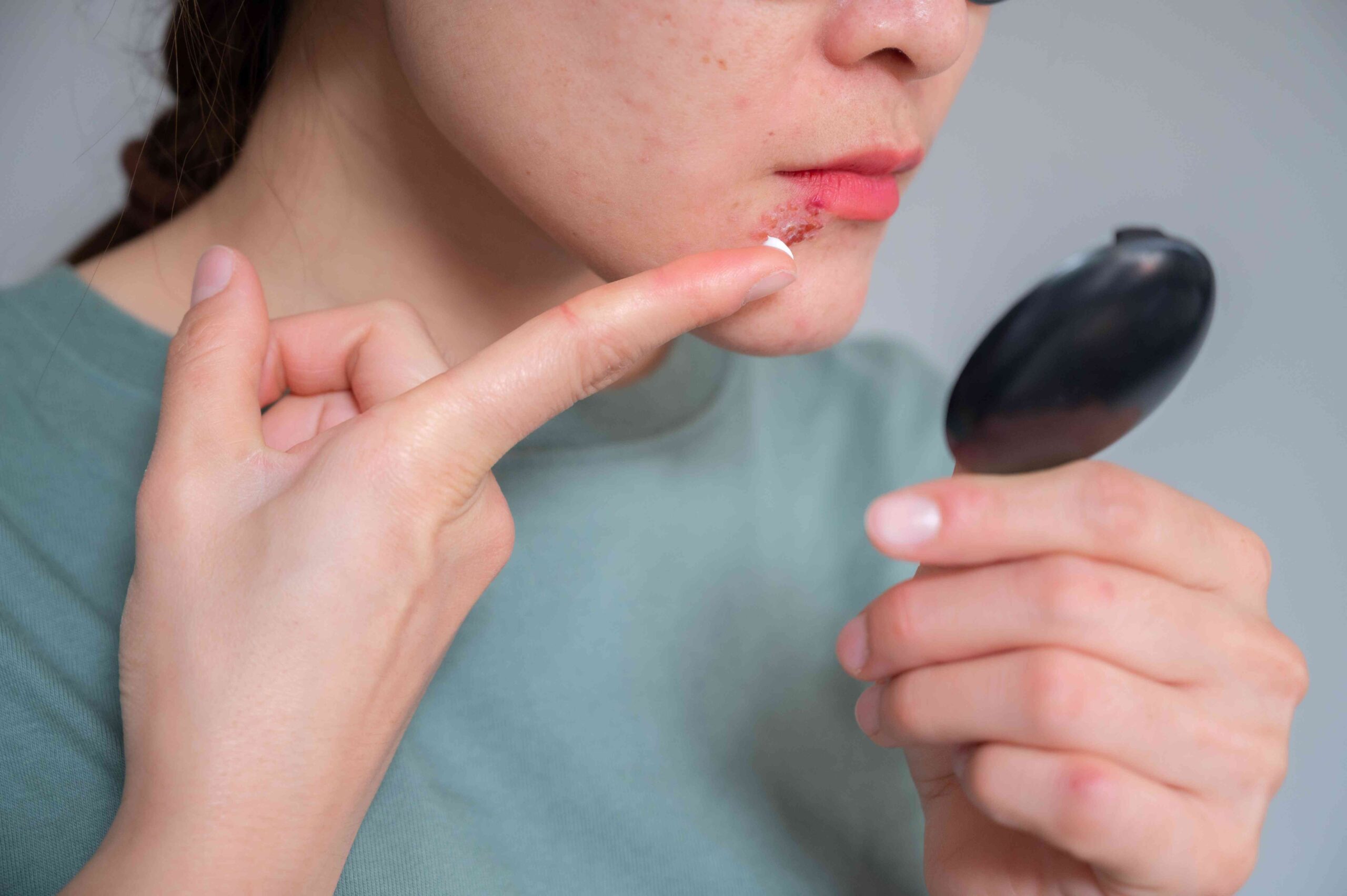 Acne Around Mouth: Why It Happens and How to Stop It