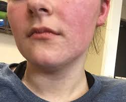 amoxicillin rash pictures